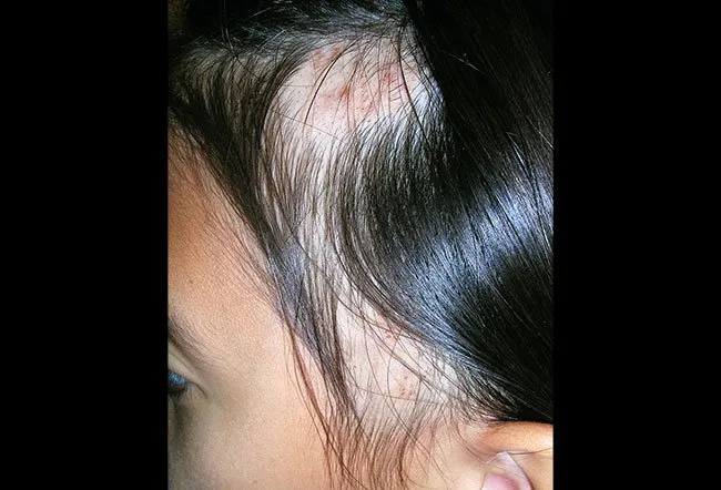Phototake photo of scalp psoriasis at hairline